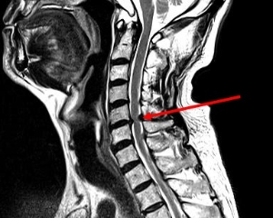 頚椎ＭＲＩ検査の写真